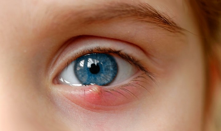 Возникновение ячменя на глазу и его лечение