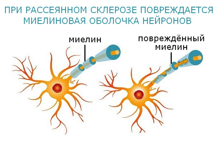 Схема поврежденных нейронов при рассеянном склерозе
