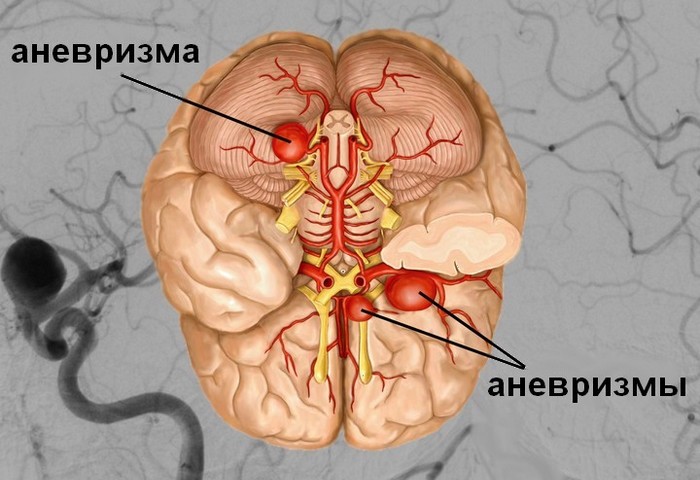 Аневризмы головного мозга