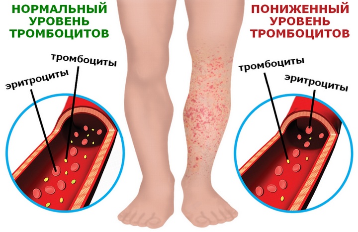 Схема нормального и пониженного уровня тромбоцитов в крови