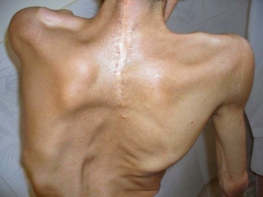 Спина человека, больного фибродисплозией