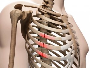 Переломы ребер и грудины – самая распространенная травма при несчастных случаях