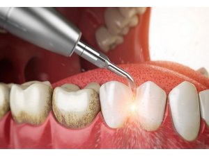 Зубной камень. Как от него избавиться и как предотвратить появление?