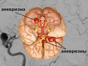 Аневризма головного мозга: симптомы, лечение