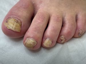 Грибок ногтей на ногах. Профилактика и лечение
