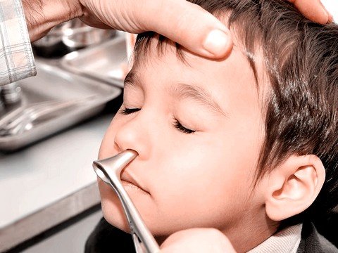 Искривление перегородки носа у детей: частое воспаление и затруднение носового дыхания
