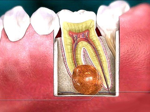 Киста зуба: причины возникновения, лечение