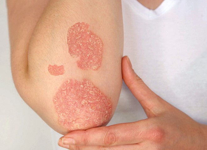 Псориаз – неинфекционное заболевание кожи