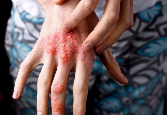 Экзема – воспалительное заболевание кожи